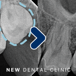 오이도역사랑니발치